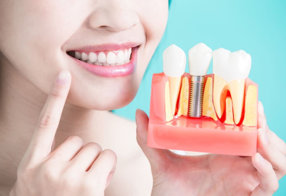 Implant dentar clinica stomatologica sectorul 1.